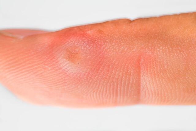 FINGER MED VORTE: Smitter ofte fra person til person Foto: NTB Scanpix/Shutterstock FINGER MED VORTE: Smitter ofte fra person til person Foto: NTB Scanpix/Shutterstock